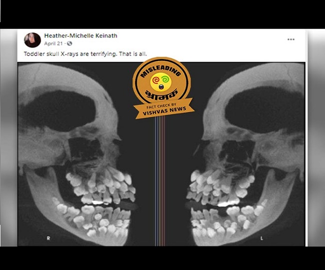 Fact Check Story: Photo of an X-Ray in the post is a condition named Hyperdontia; not a generic toddler scan
