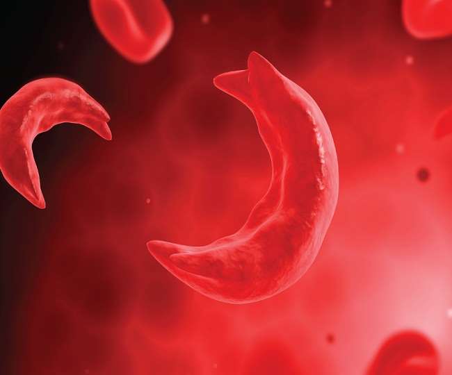 World Sickle Cell Day 2021: Check out symptoms, treatment and stem cell ...