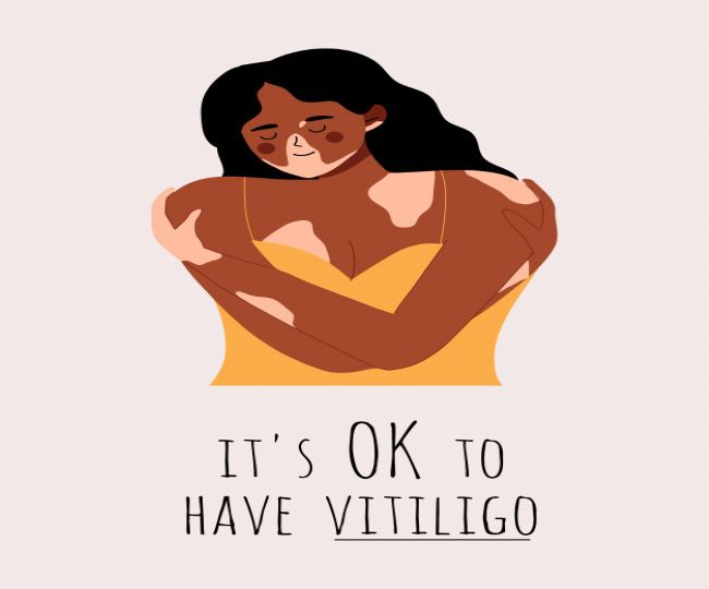 Vitiligo Awareness Month 2024 Erma Odetta