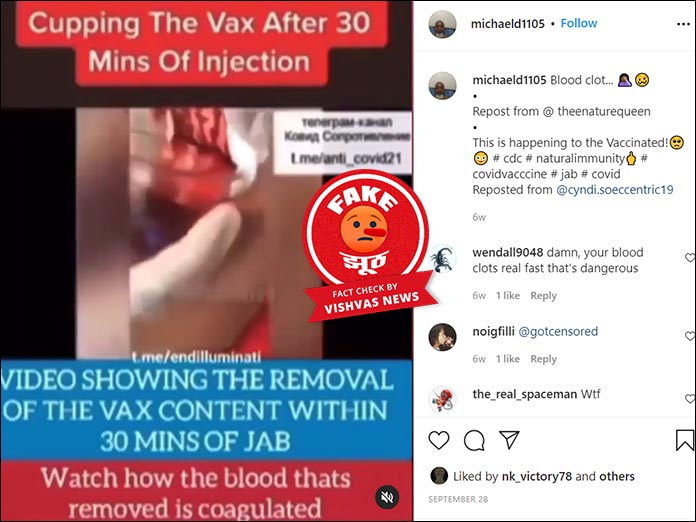 Fact Check Story: No, Cupping Cannot Remove COVID-19 Vaccine Content From The Body, Viral post is fake