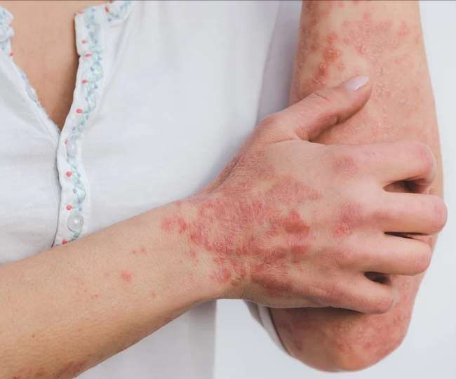 World Psoriasis Day 2021: From symptoms to triggers of Psoriasis; here's all you need to know 