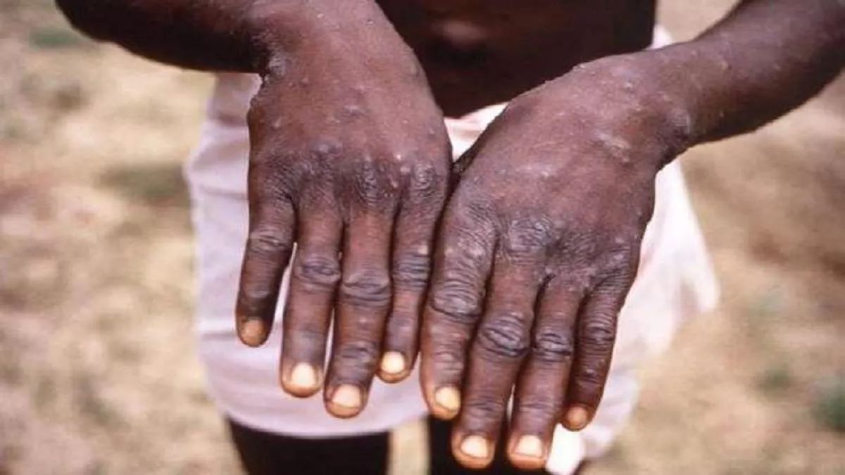 Monkeypox Vaccines Efficacy Below 100 Per Cent, Says WHO