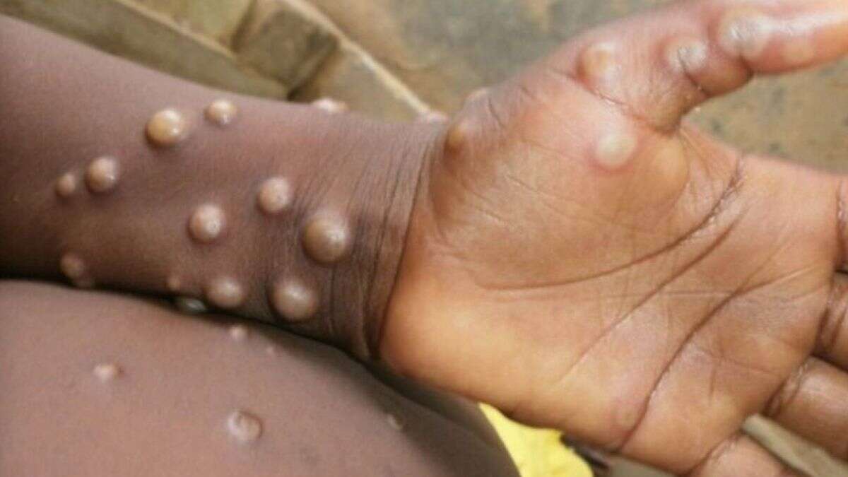 Delhi Reports 2nd Monkeypox Case As African National With No Travel History Tests Positive
