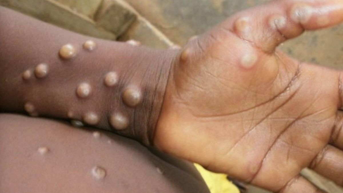 Monkeypox Virus: How To Prevent Monkeypox? Know Its Symptoms And Other Details Here