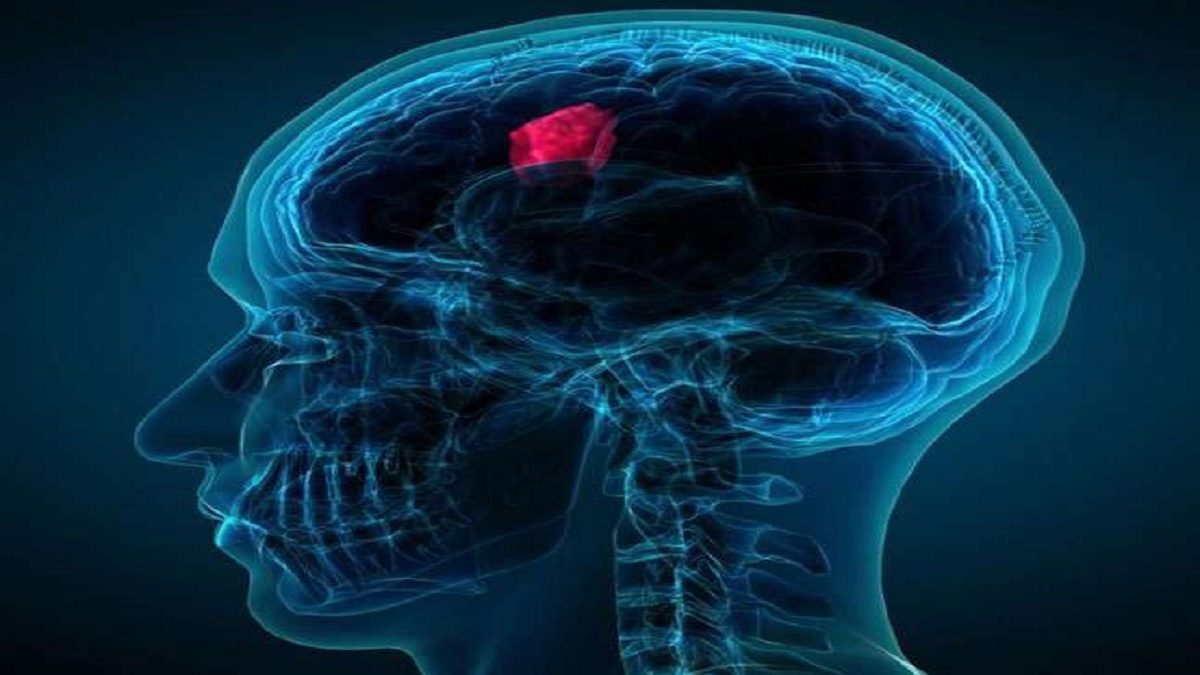 World Brain Tumour Day 2022: Know Causes And Symptoms And Its Prevention