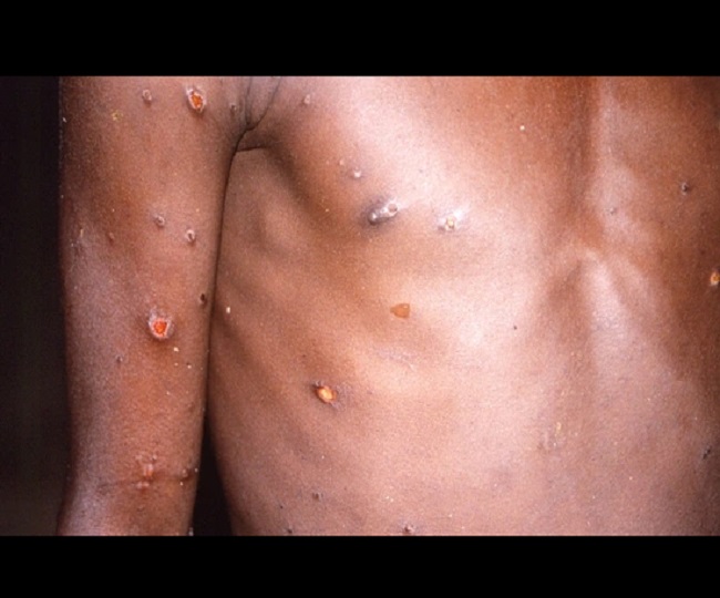 92 confirmed monkeypox cases reported from 12 countries; WHO expects more cases globally | 10 Points