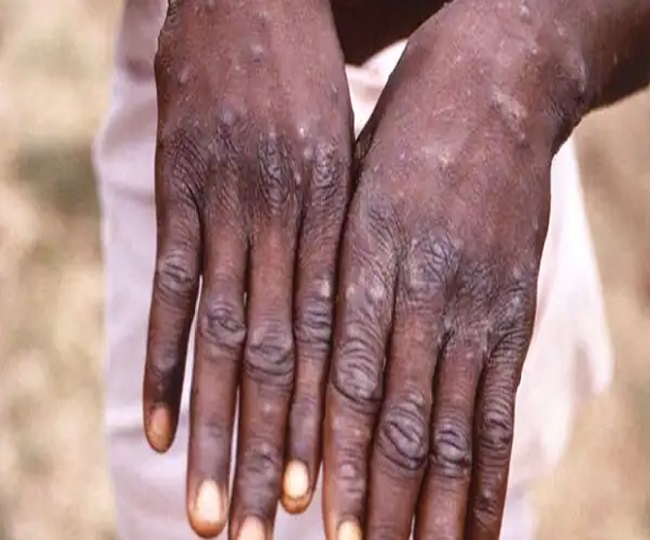 Monkeypox threat looms over the world as countries report new cases. What is India's preparation?