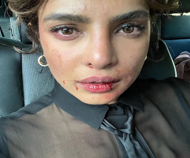 'What happened': Worried fans ask Priyanka Chopra as she shares selfie with bruised face