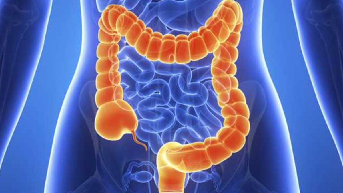 What Is Colon Cancer? Know Its Causes, Symptoms And Different Types