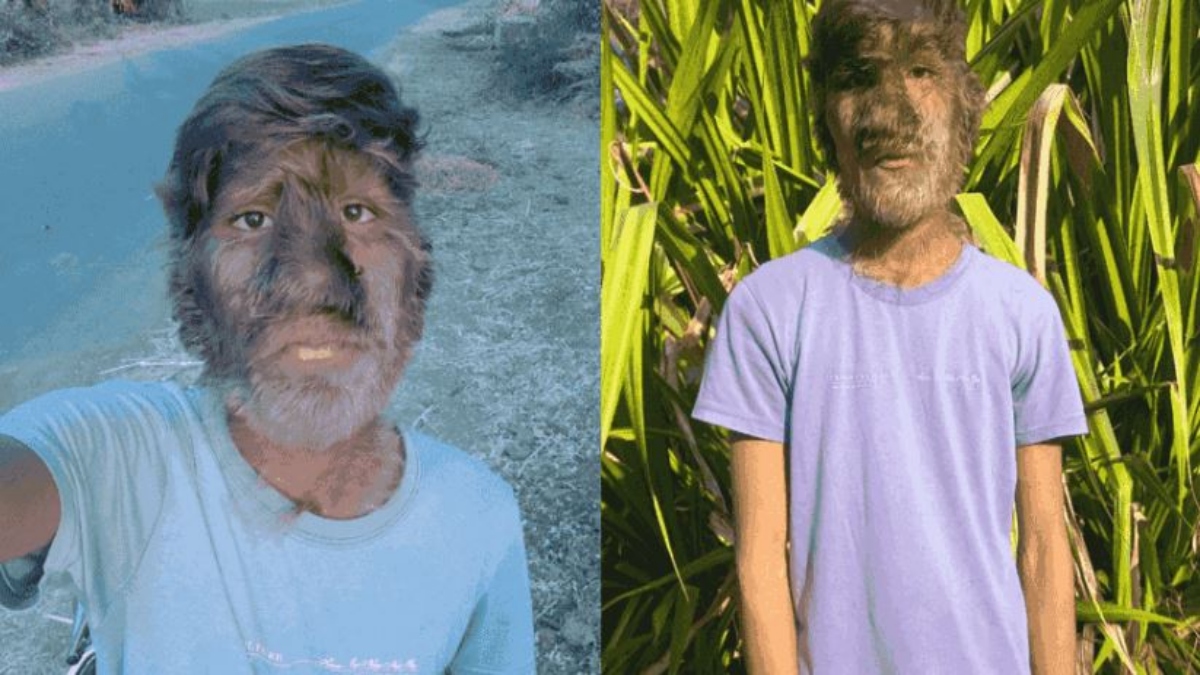 What Is Werewolf Syndrome? All You Need To Know About The Rare Condition Diagnosed In Teenage Boy From Madhya Pradesh