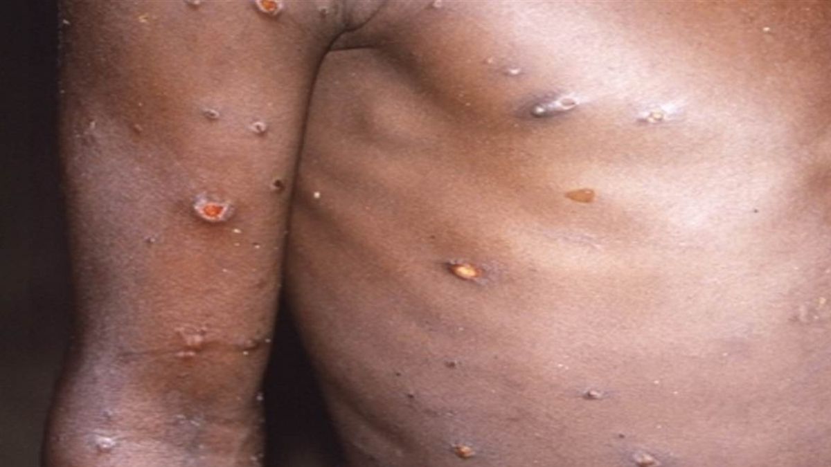 Another Nigerian Woman Tests Positive For Monekypox In Delhi; Total Cases In India Reach 13