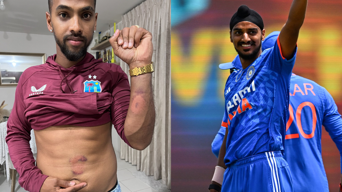 nicholas-pooran-posts-picture-of-ugly-bruise-from-arshdeep-singh-delivery-during-5th-t20i-ind-vs-wi