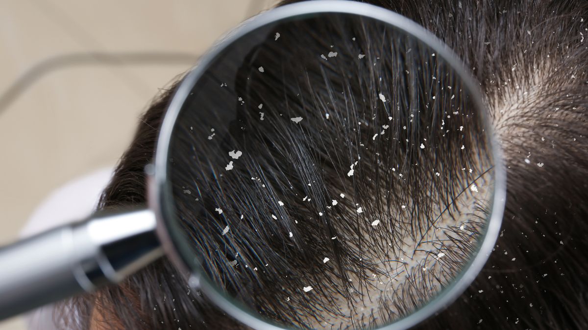 Home Remedies For Flaky Scalp 4 DIY Masks To Get Smooth And Lustrous Hair