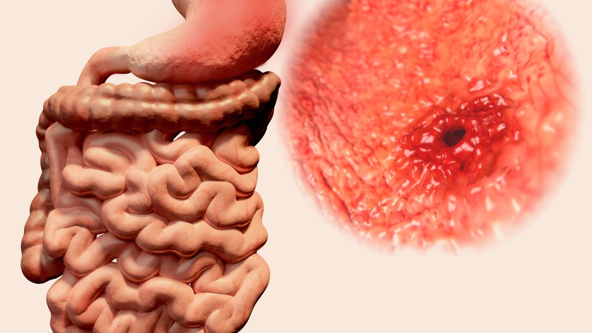 Home Remedies For Stomach Ulcers Honey To Chamomile Tea; 5 Ways To Get