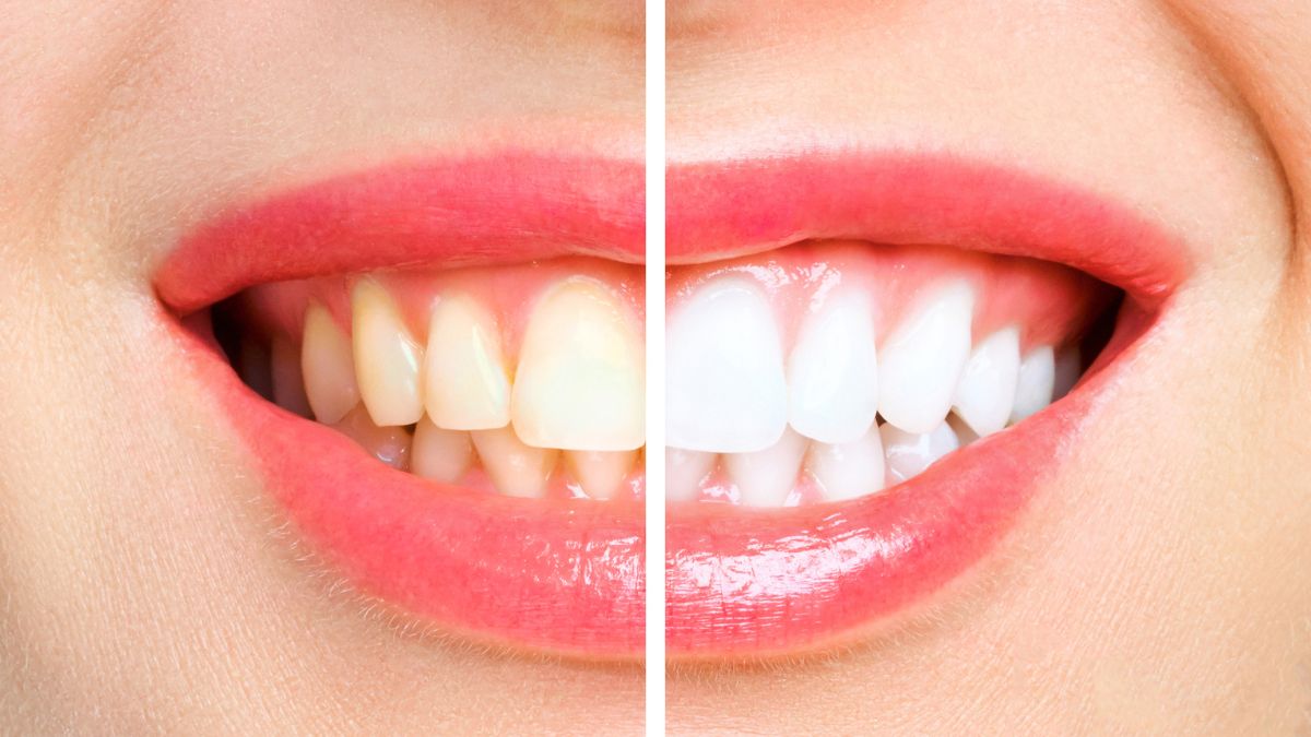 expert-shares-actual-cause-behind-teeth-turning-yellow-know-how-to-get-rid-of-them