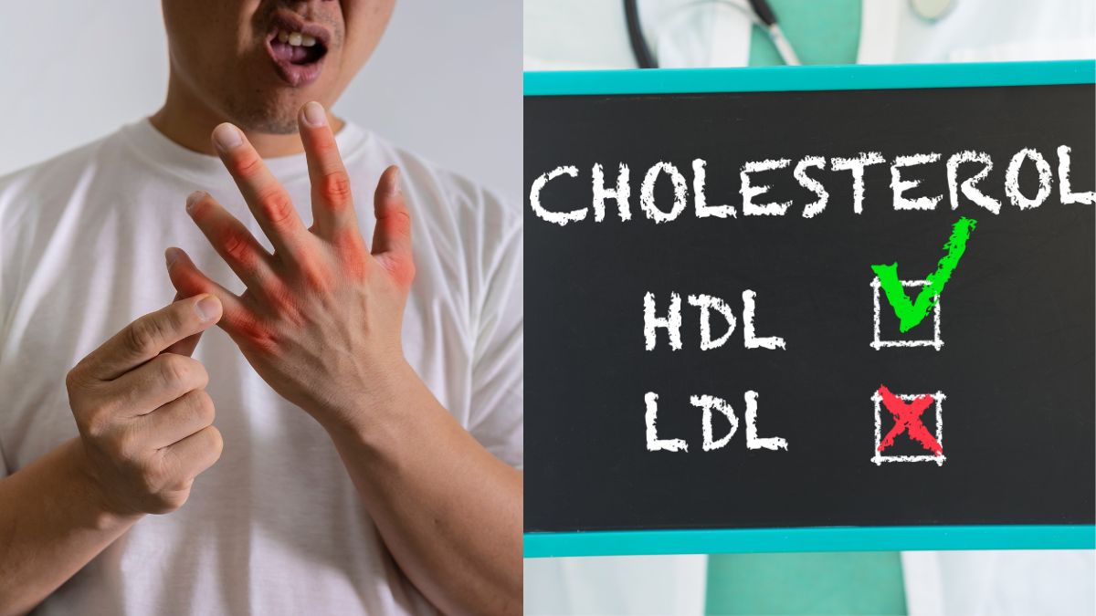 Can High Cholesterol Cause Uric Acid? 5 Simple Ways To Keep It In Control