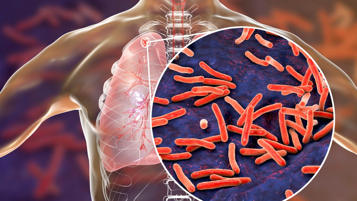 what-is-tuberculosis-what-are-its-causes-symptoms-and-treatment