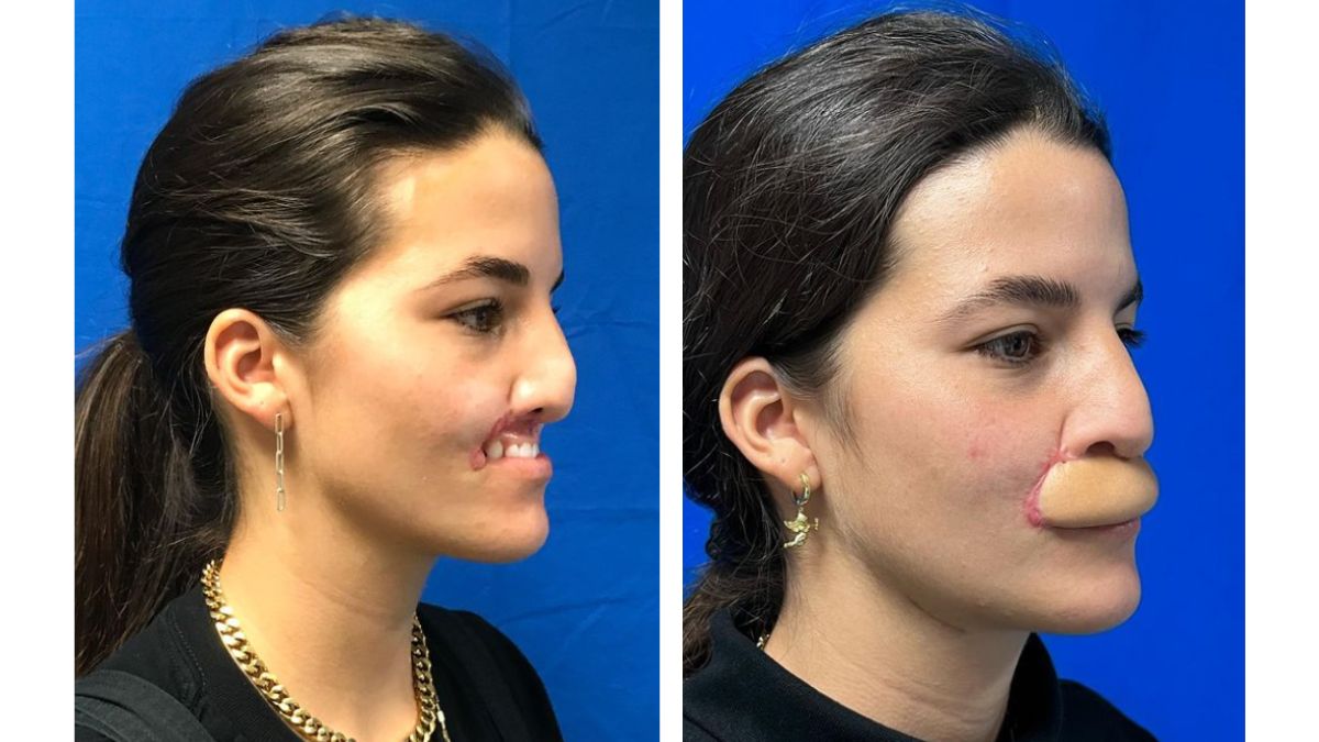 Viral: US Model Reveals Her Face After Her Lip Got Bitten By A Dog | See Pics
