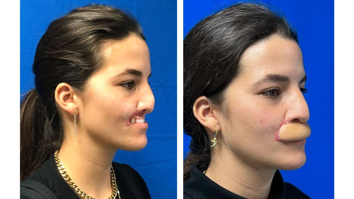 Viral US Model Reveals Her Face After Her Lip Got Bitten By A Dog 