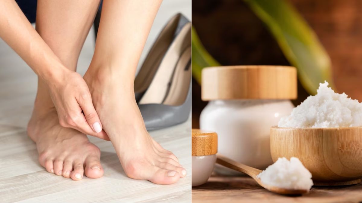 Home Remedies for Cracked Heels in Winter – MyCocoSoul-hkpdtq2012.edu.vn
