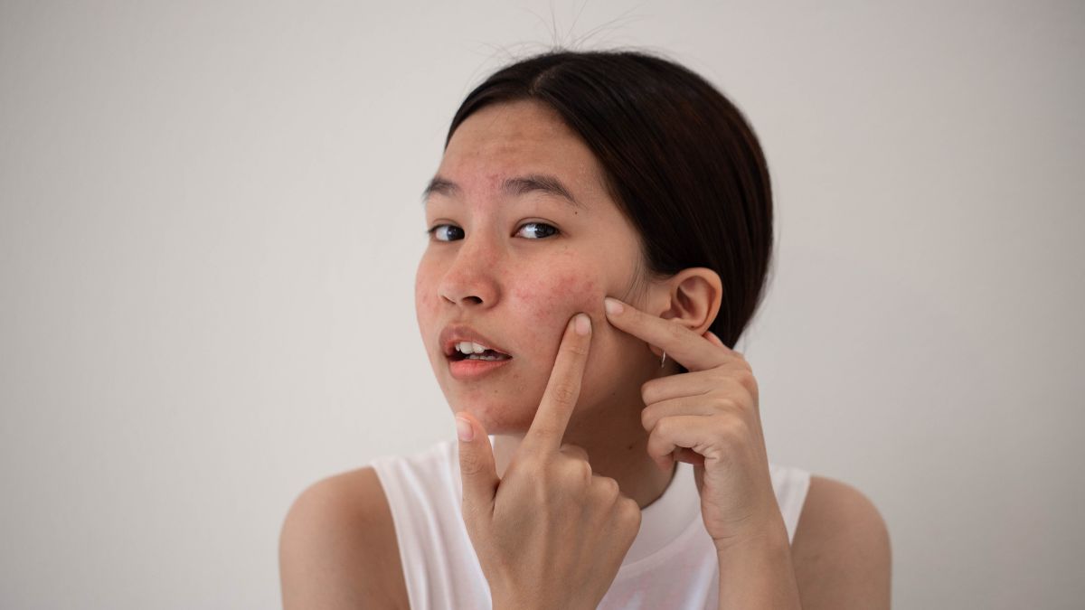 5 Unhealthy Habits That Can Trigger Acne During Winters