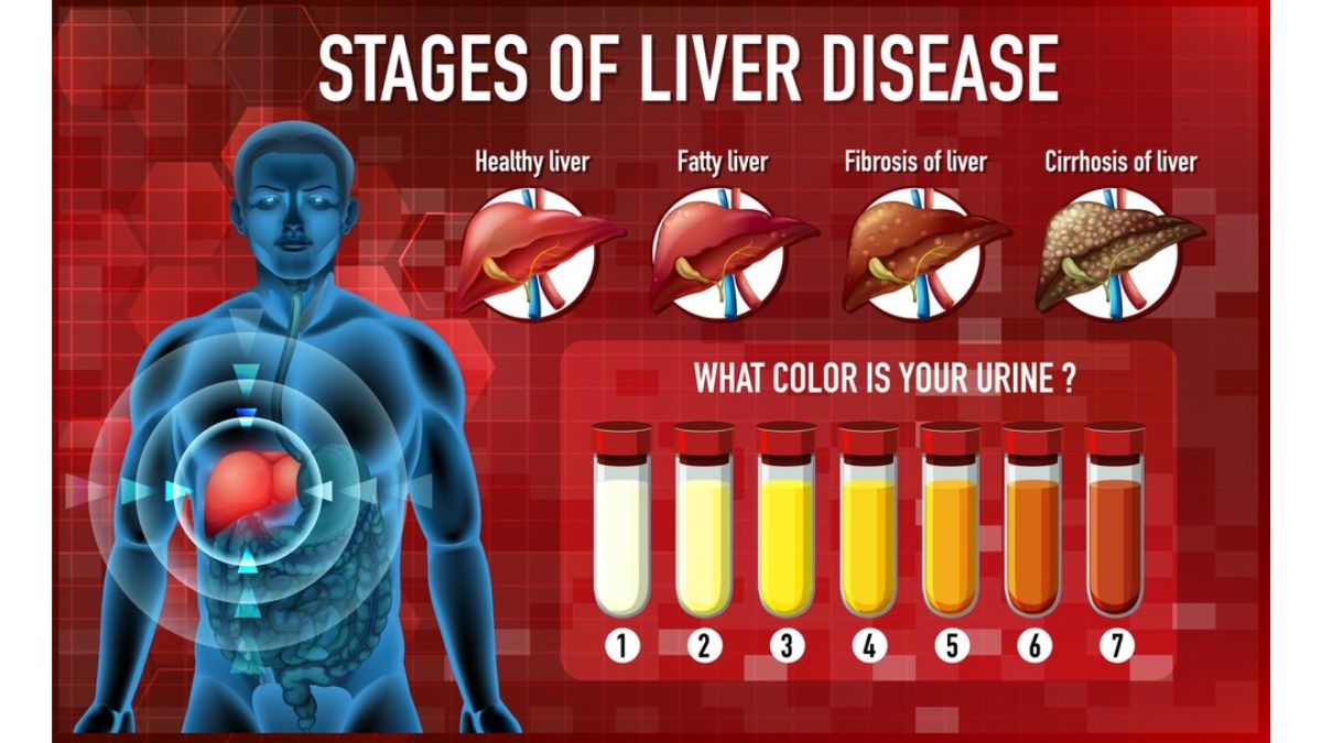 5 Effective Ways To Avoid NonAlcoholic Fatty Liver Diseases