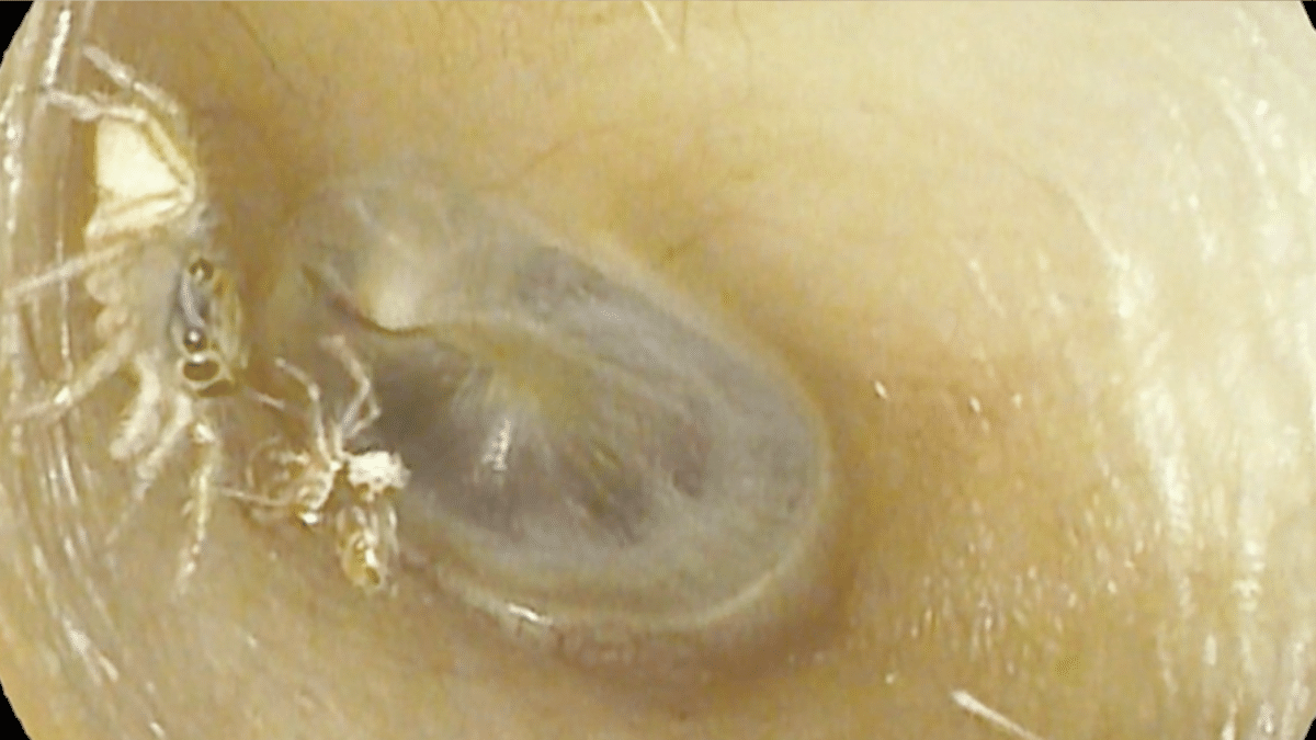 shocking-video-spider-in-woman-ear-hears-clicking-and-rustling-sounds-what-happened-next-watch