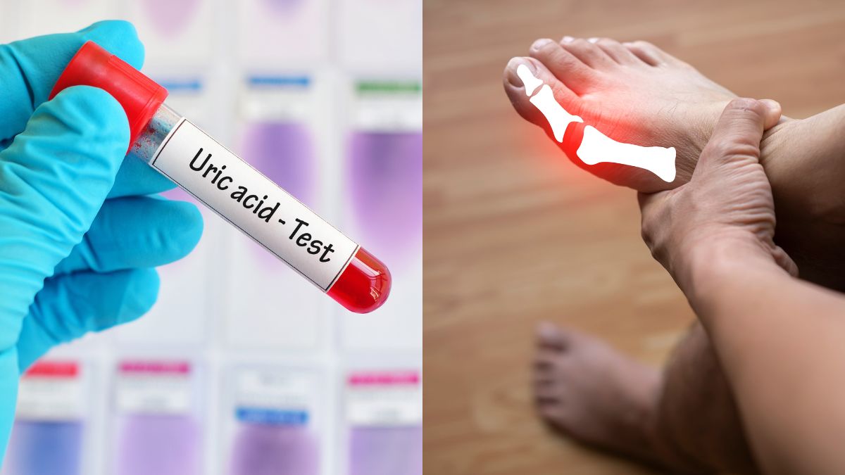 what-is-the-gout-diet-avoid-these-5-food-items-to-reduce-uric-acid-naturally