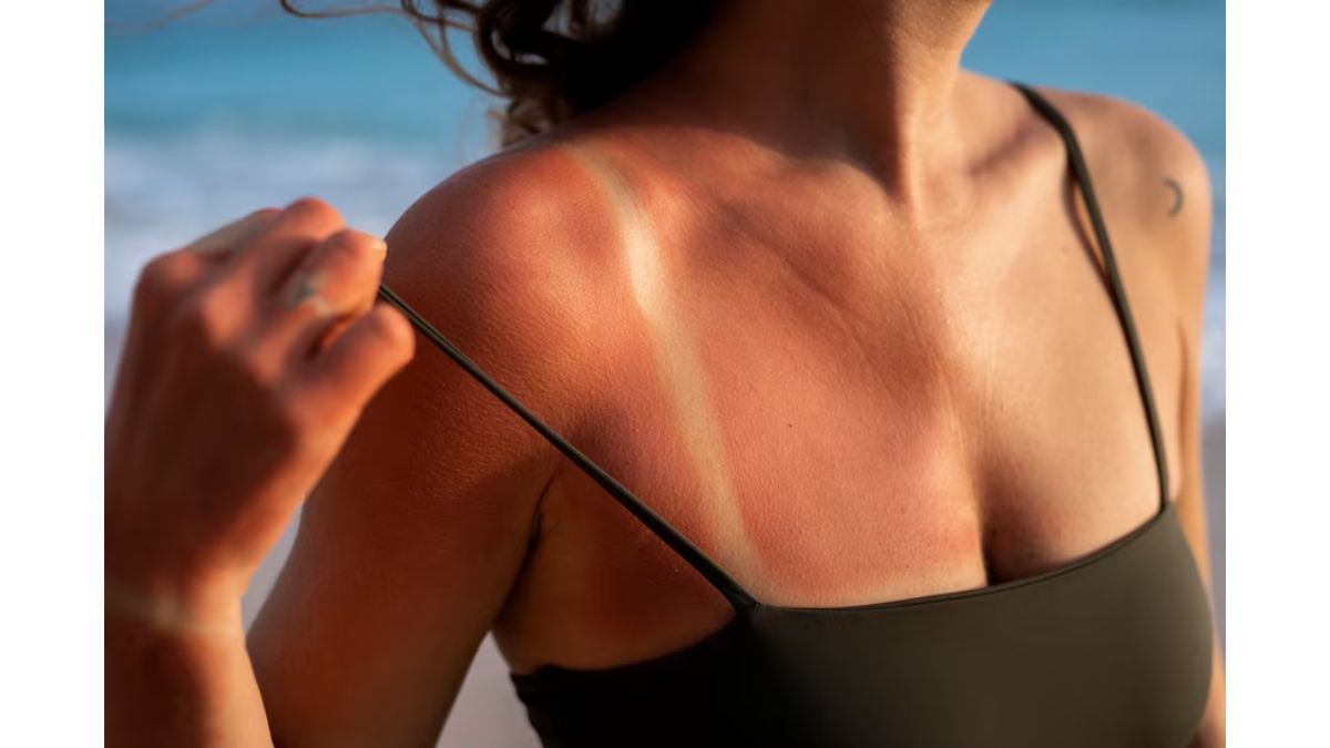 5 Surprising Ways How Summer Affects Your Skin