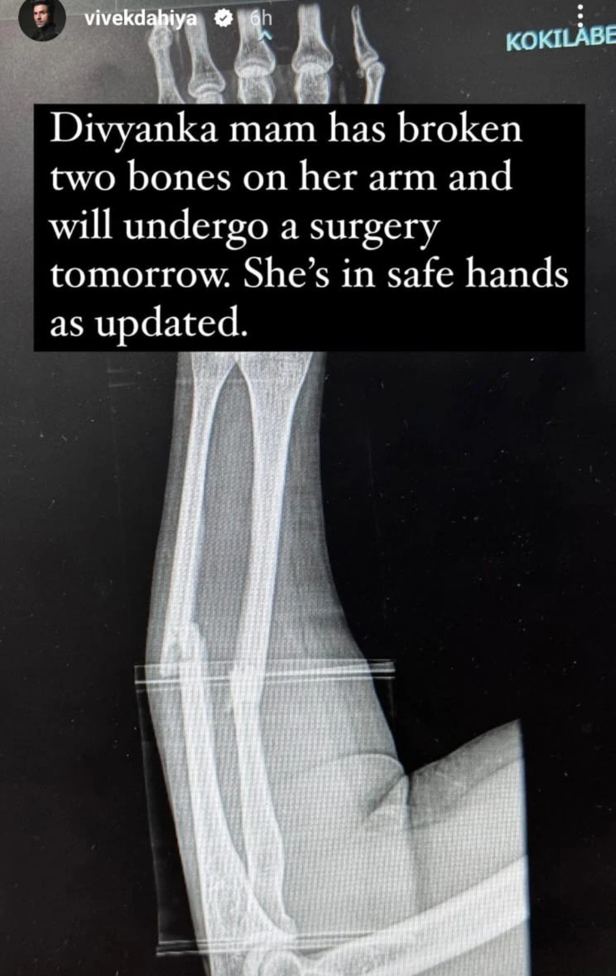 Divyanka Tripathi's Xray