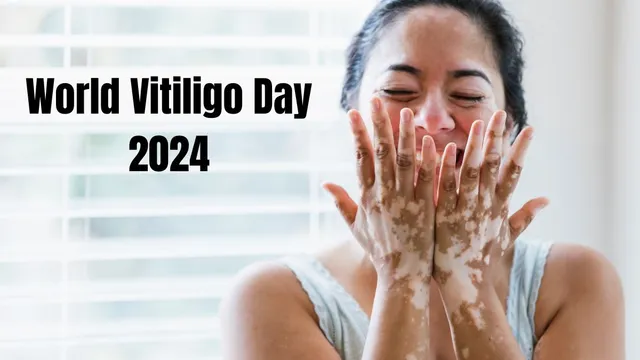 world-vitiligo-day-2024-date-history-significance-and-slogans-everything-you-need-to-know-about-this-day