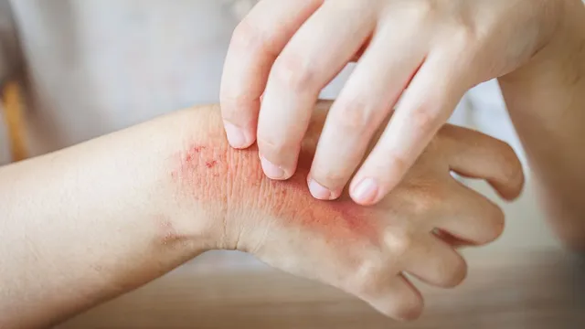 5-effective-ways-to-keep-fungal-infections-at-bay-during-monsoon