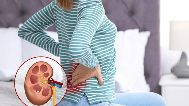 5-effective-tips-to-get-relief-from-excruciating-pain-of-kidney-stones