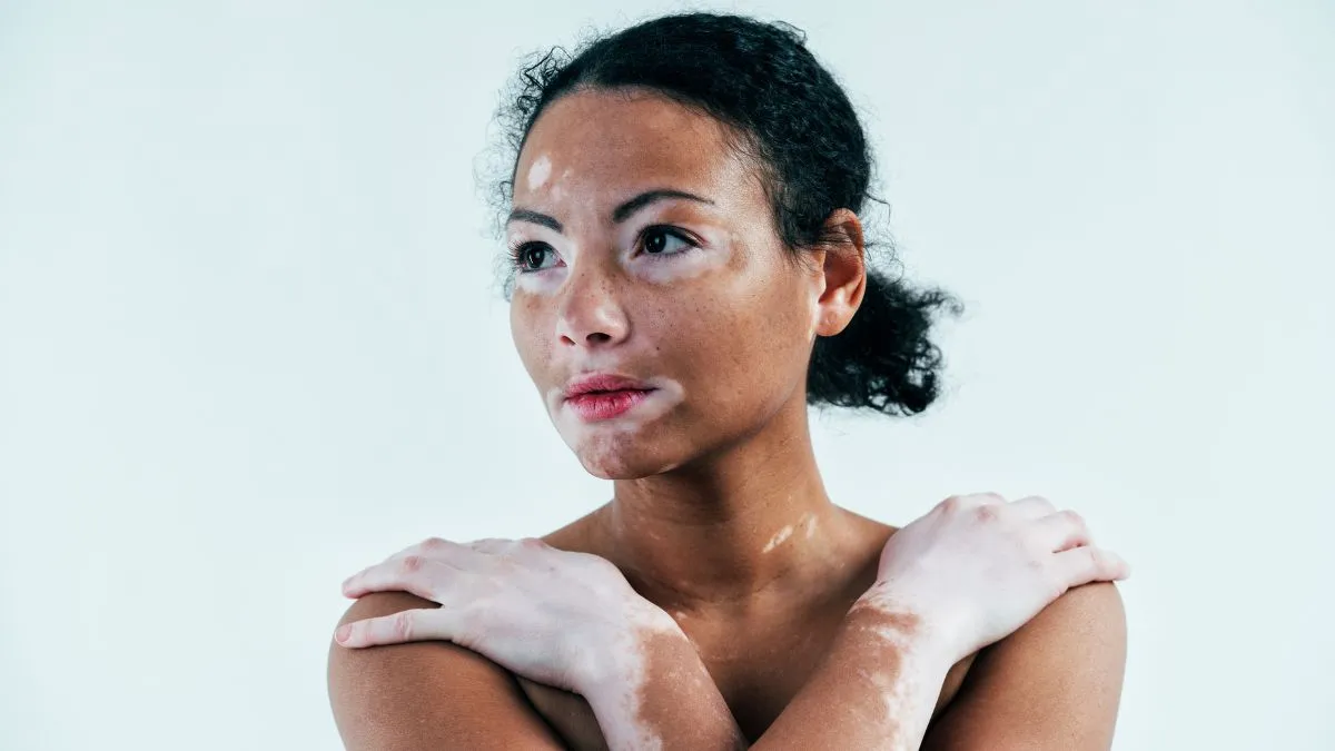 7-expert-recommended-mental-health-strategies-for-coping-with-vitiligo-related-anxiety