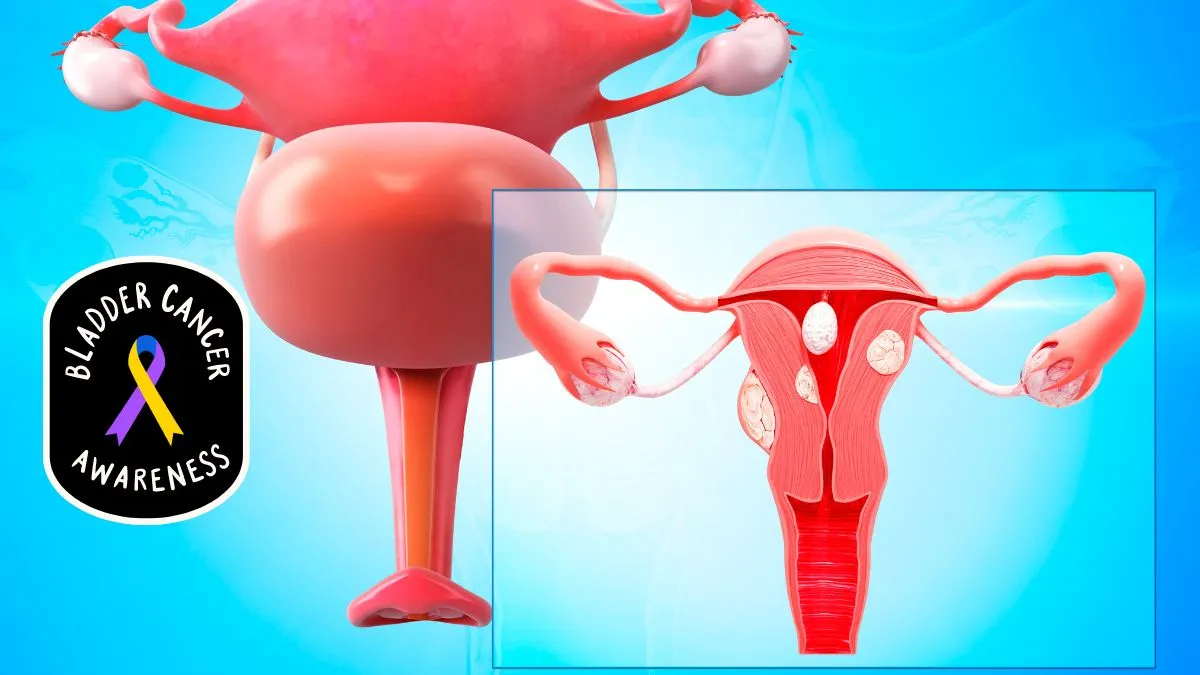 what-is-bladder-cancer-know-about-its-symptoms-and-causes-from-expert