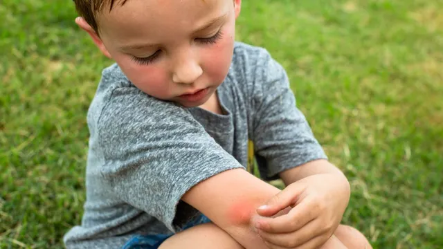 expert-reveals-dangerous-health-risks-associated-with-mosquito-bites