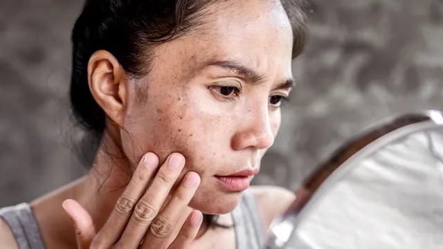 5-natural-home-remedies-to-reduce-pigmentation-from-face