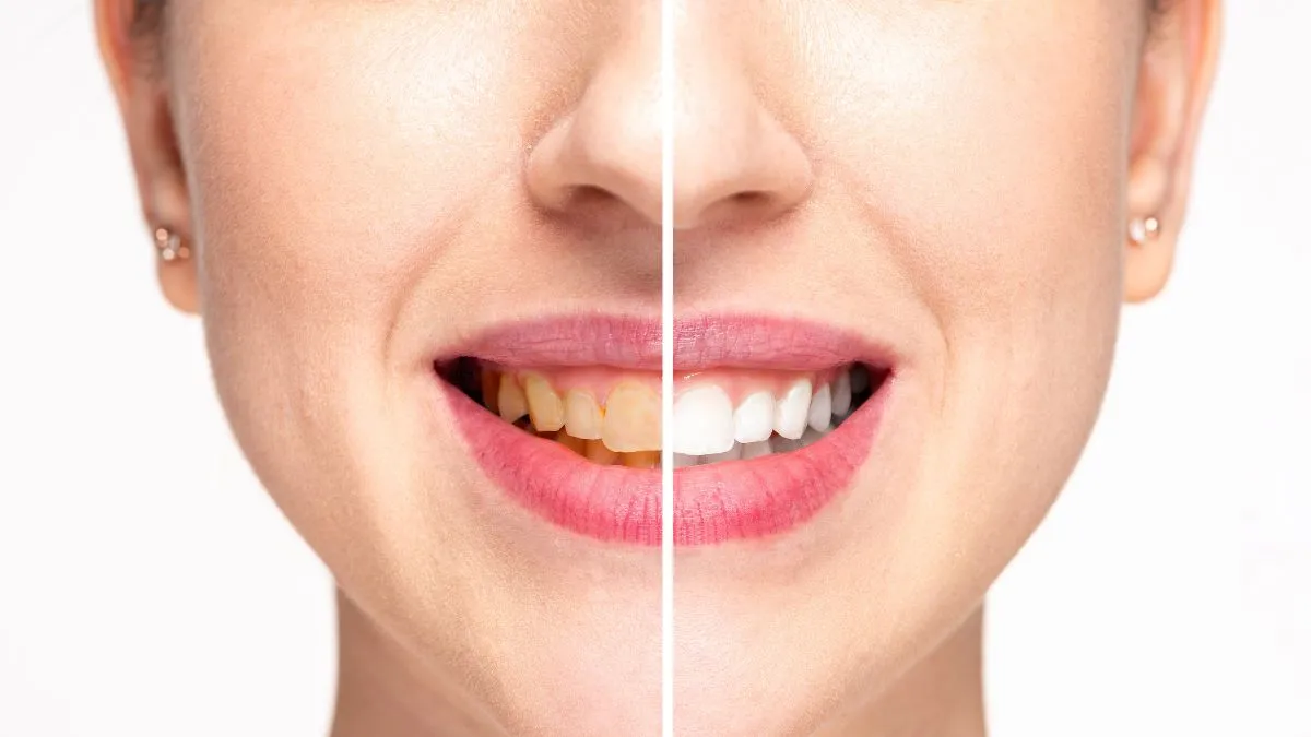 check-these-5-simple-home-remedies-to-easily-get-rid-of-yellow-teeth-and-achieve-a-whiter-smile