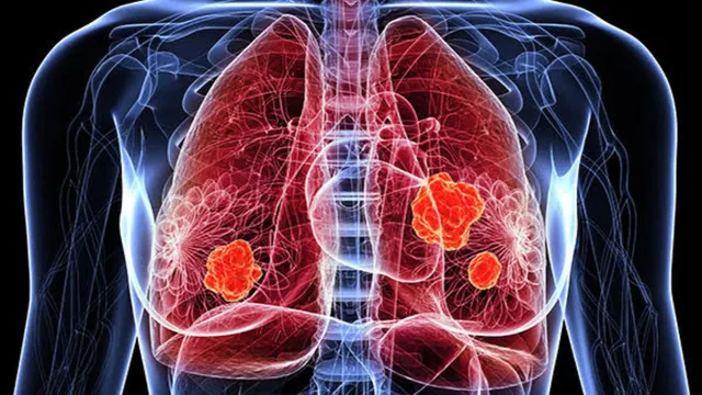 know-from-expert-about-what-is-hypersensitive-pneumonitis-and-what-is-its-role-specially-in-lung-diseases