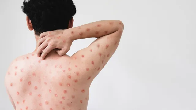 quickest-methods-to-test-for-mpox-infections-know-from-expert