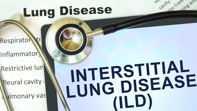 what-is-interstitial-lung-disease-expert-explains-importance-of-timely-diagnosis-and-treatment
