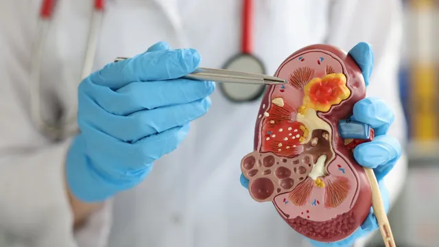 can-kidney-stones-cause-cancer-heres-what-expert-has-to-say