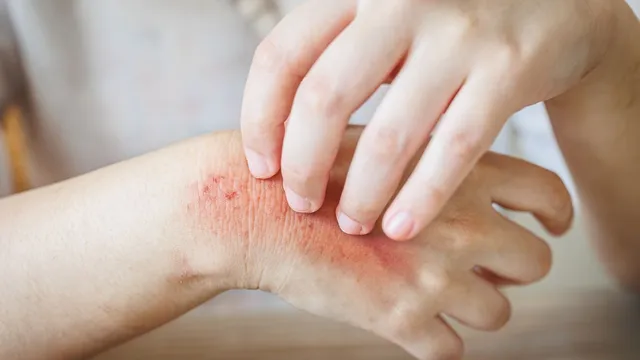 5-best-home-remedies-to-cure-fungal-infections-quickly