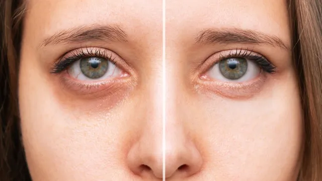 dark-circles-or-panda-eyes-expert-lists-tips-to-reduce-dark-circles