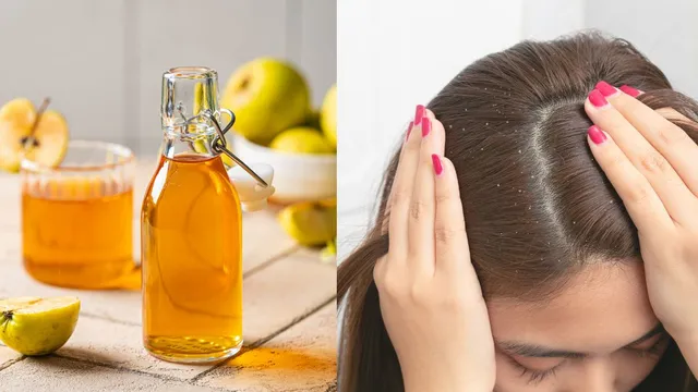 4-ways-to-use-apple-cider-vinegar-for-treating-dandruff-at-home