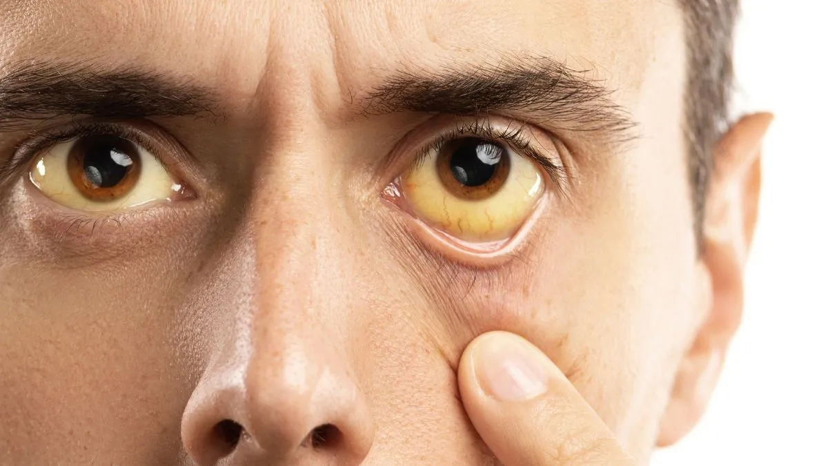 can-jaundice-be-a-sign-of-pancreatic-cancer-doctor-lists-major-signs-and-symptoms-to-watch-out-for