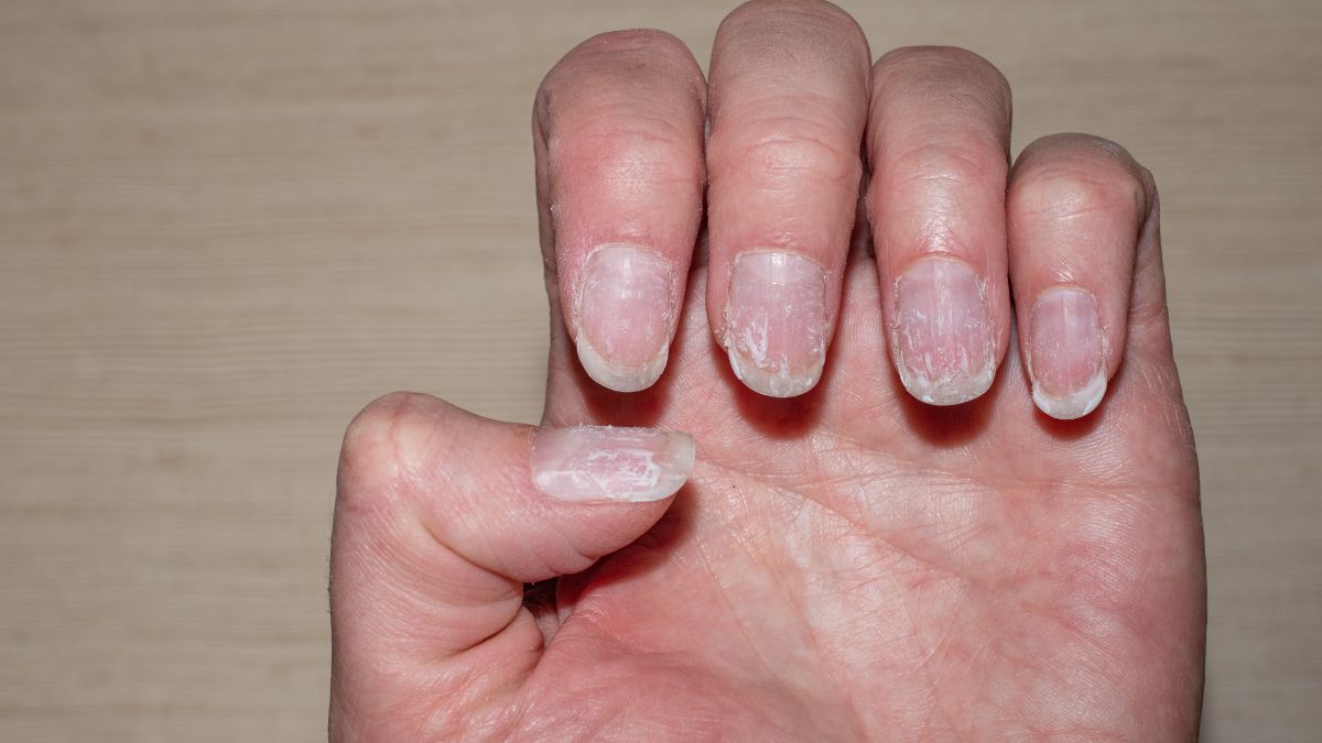 common signs of vitamin deficiency (1)