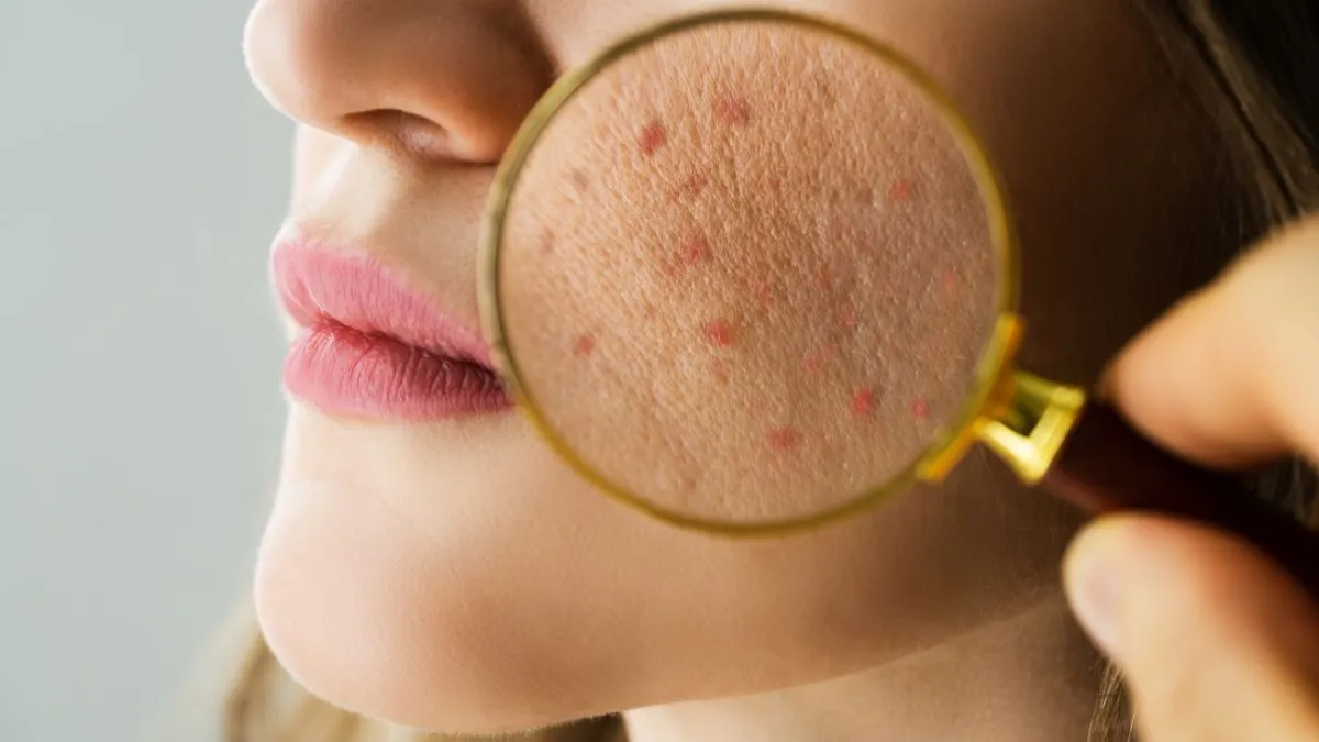 nutritionist-lists-tips-for-balancing-hormones-and-preventing-acne-and-other-skin-issues