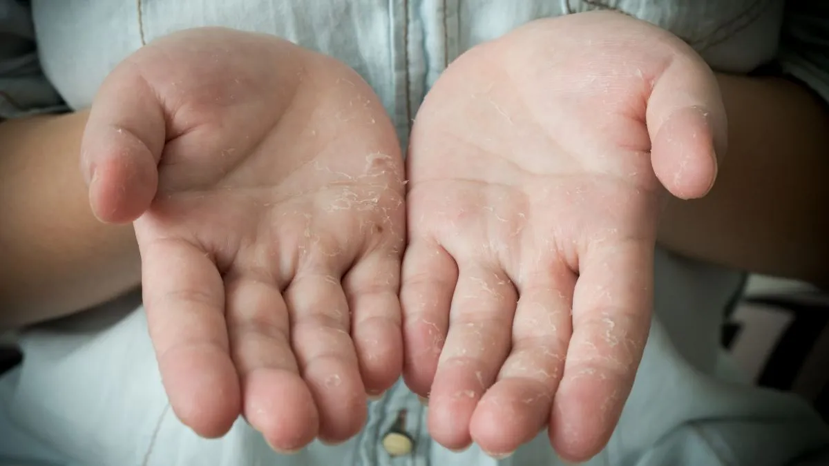 5-simple-home-remedies-to-treat-dry-and-flaky-skin-in-winter