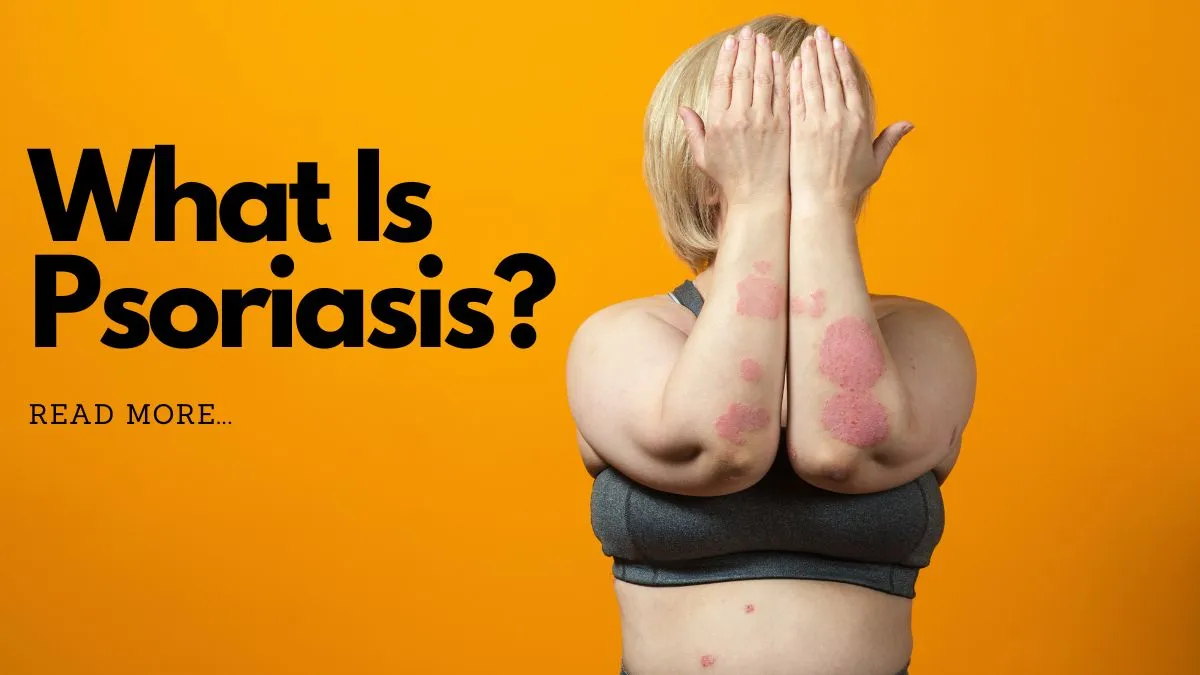 what-is-psoriasis-expert-advice-on-how-you-can-treat-this-skin-issue